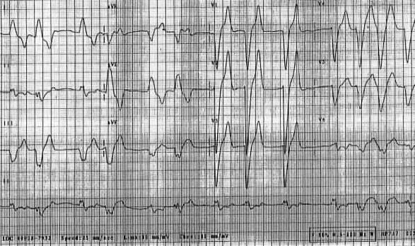 ***K değeri 7,5 meq/l ve üzerinde; QRS komplekslerinin amplitüdü düşer ve daha da