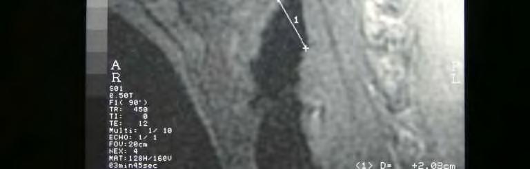 A Şekil 12. A. Grup II e ait erkekten alınan MR görüntüsü. ı: lig. thyrohyoidea laterale dextra nın ölçümü.