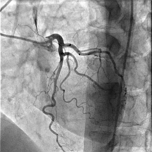 Normal sol koroner arter Normal sağ koroner arter Koroner arterler 3-4 mm