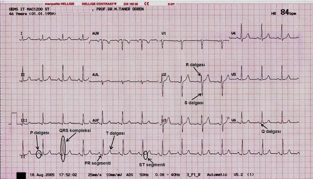 Normal EKG Kalbin elektriksel ana vektörünün yönü: Arkadan öne, sağdan sola, yukarıdan aşağıya. 12 derivasyon: Kalbin ana vektörüne farklı açılardan bakan 12 göz.