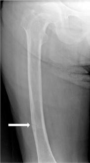 (b) Femoral ve (c) ulnar yetmezlik kırıkları (beyaz oklar). (d) Sağ femurda aşırı medial femoral eğriliğin çivi geçişini zorlaştırdığını gösteren operasyon esnasındaki floroskopi görüntüsü.