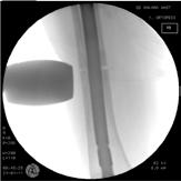 Tartışma Olgularımızdaki en önemli bulgu aşırı medial femoral eğilimin mevcudiyeti idi. Einhorn ve ark.