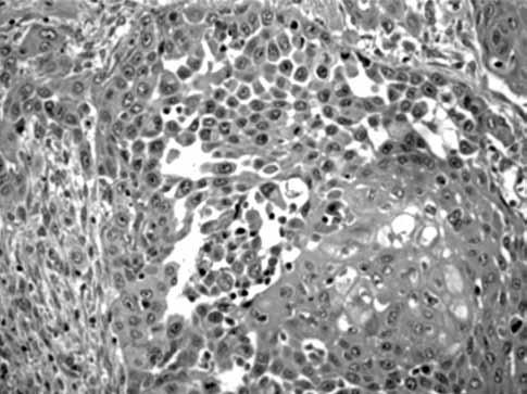 Skuamöz hücreli kanserin nadir bir varyantı olarak larenks akantolitik skuamöz hücreli kanseri 177 peniste tespit edilen olgular da bildirilmiştir.