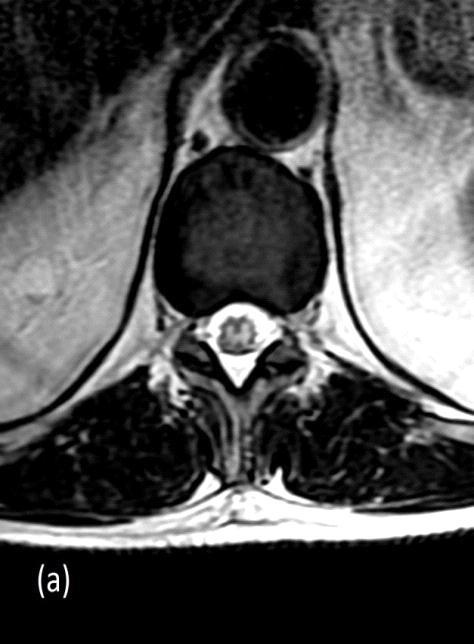 Konus medullaris sendromu Resim II: T11-12 den geçen aksiyel T2 görüntüde Owl s eyes bulgusu (a), DSA incelemede Adamkiewicz arteri (açık beyaz oklar)(b), koronal reformat BT incelemede abdominal