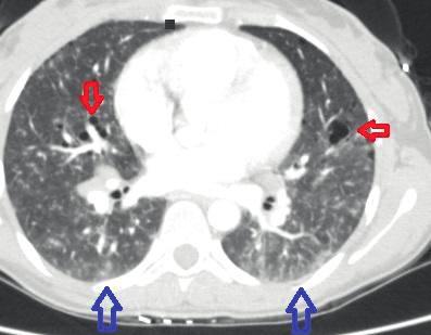 Kaynaklar: 1-Statement on sarcoidosis.