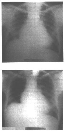 Tablo 1 de her iki olgunun preoperatif ve postoperatif 12.