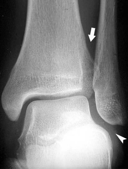 Olgu 8 A: Mortise grafisi: Distal tibiofibular eklem biraz genişlemiştir (arrow) eklem aralığı medial eklem