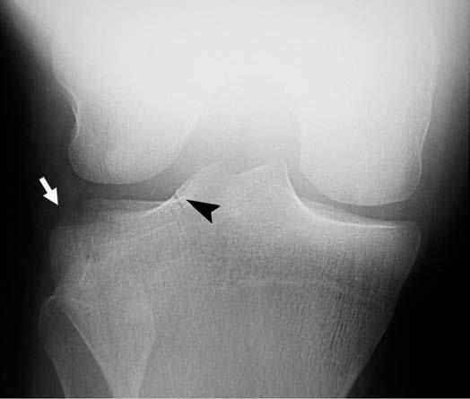 Normal lateral grafi: Hem medial ve lateral tibial plato (arrowheads) hem de femoral kondiller birbirinin üstüne binmiştir.