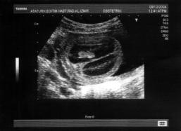 50 Bezircio lu ve ark., Osteogenezis Imperfektan n Prenatal Tan s Girifl 16. gebelik haftas nda prenatal ultrasonografi ile tan s konularak sonland r lan Osteogenesis imperfekta tip II olgusu sunuldu.