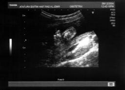 Olgu 19 yafl nda, G2P1, normal bir erkek do urmufl olan olgunun, bu gebeli inin 16. haftas nda ilk kez yap lan ultrasonografisinde fetusta yap sal defekt saptanmas üzerine klini imize refere edildi.