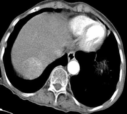 DEB TAKE öncesi arteriyel faz BT incelemede karaciğer sağ lobta