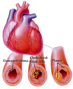 KDH da temel mekanizma: Ateroskleroz Damarın intima tabakası hasarlanır Kolesterol birikir Bir ya da daha fazla plak,