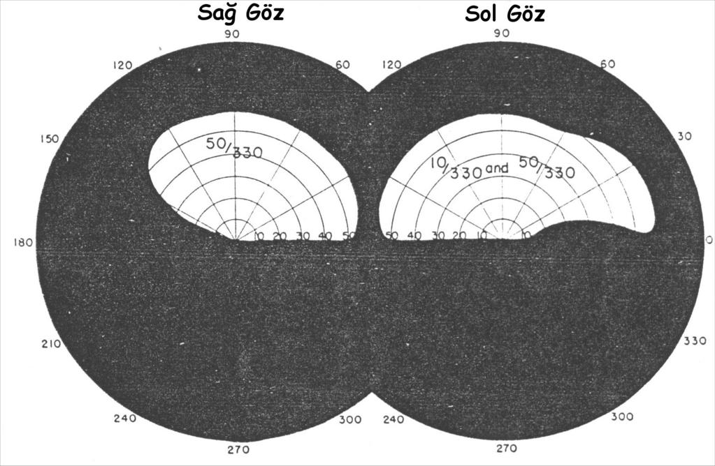 Şekil 6: Travmatik optik nöropatili hastanın görme alanı testi Bu olgu için İşlevsel Alan Puanı (İAP) [3 + 4 + (3x4)]/ 38 dir.