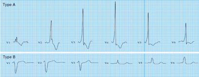 Pre-eksitasyon Sendromları Pre-Eksitasyon Sendromları Wolf parkinson white sendromu Lown-Ganong-Levine sendromu Kent bundle (WPW) James fibers (LGL syndrome) 55 WPW EKG özellikleri;