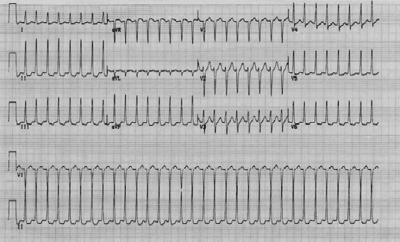 Atrial Fibrilasyon Atrial Fibrilasyon Unstabil hastalara senkronize kardiyoversiyon uygulanır Bifazik defibrilatör: 120-200 J Monofazik defibrilatör: 200 J Stabil hastalarda hız kısıtlayıcı ajanlar