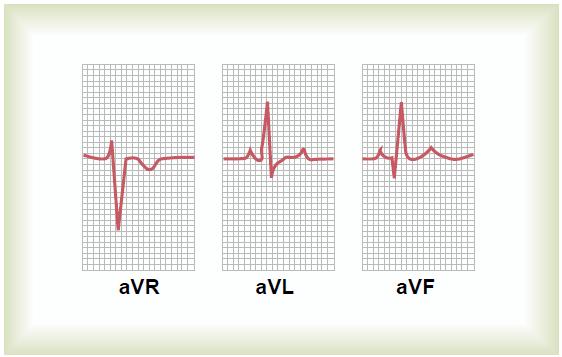avl derivasyonu; sol bacakta olursa, avf derivasyonu denir. Şekil 2.10 da bu derivasyonda kaydedilen elektrokardiyogram işaretleri gösterilmektedir. 2.5 Aritmiler Şekil 2.