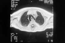 Sol arkus aorta ile birlikte de üçüncü olguda oldu u gibi sa subklavyen arterin aberan olarak desandan aortadan ç k fl görülebilir.