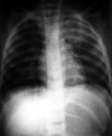 Kurus k tabanca at fl sonucu geliflen juguler ven yaralanmas OLGU SUNUMU Şekil 1: Hastanın PA akciğer grafisinde sol apekste infiltratif görünüm Şekil 2: Toraks bilgisayarlı tomografisinde akciğerin