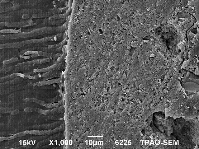 Single Bond üzerine Nd:YAG lazer uygulanan kök kanal dentini örneklerinde rezin uzantıların uzunluklarının arttığı