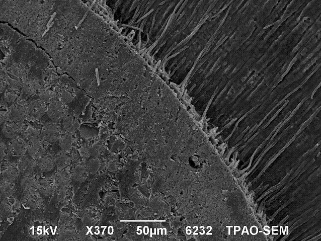 Scotchbond Multi-Purpose üzerine Nd:YAG lazer uygulanmış kök kanal dentin yüzeyinde rezin uzantıların oldukça uzadığı