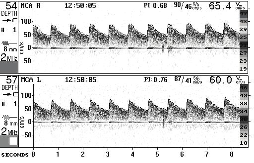 TRANSKRANYAL DOPPLER Prof. Dr.