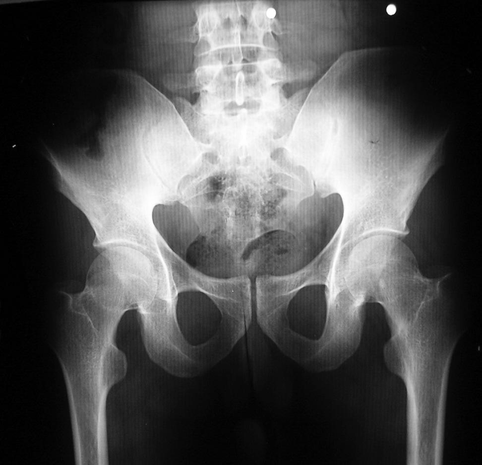 36 Genç Erkek Olguda Kalçan n Geçici Osteoporozu Osteoporoz Dünyas ndan (2008;14:35-9) Resim 1.