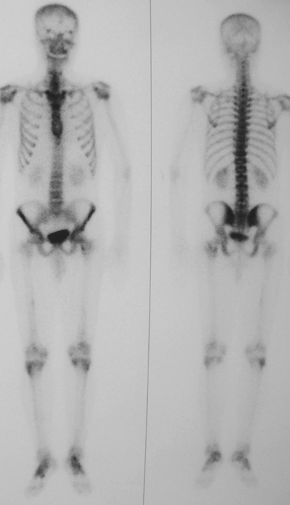 Osteoporoz Dünyas ndan (2008;14:35-9) Genç Erkek Olguda Kalçan n Geçici Osteoporozu 37 t r.