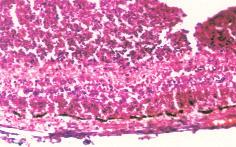 bulanýk olarak izlenebildi. Üçüncü günden itibaren tüm gözlerde 3+ vitreus opasitesi geliþti ve fundus seçilemedi.