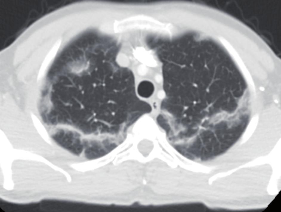 Polianjitis ile Birlikte Olan Eozinofilik Granülomatozis ve Kronik Eozinofilik Pnömoni Eosinophilic Granulomatosis with Polyangiitis and Chronic Eosinophilic Pneumonia Olgu 2 42 yaşında erkek hastaya