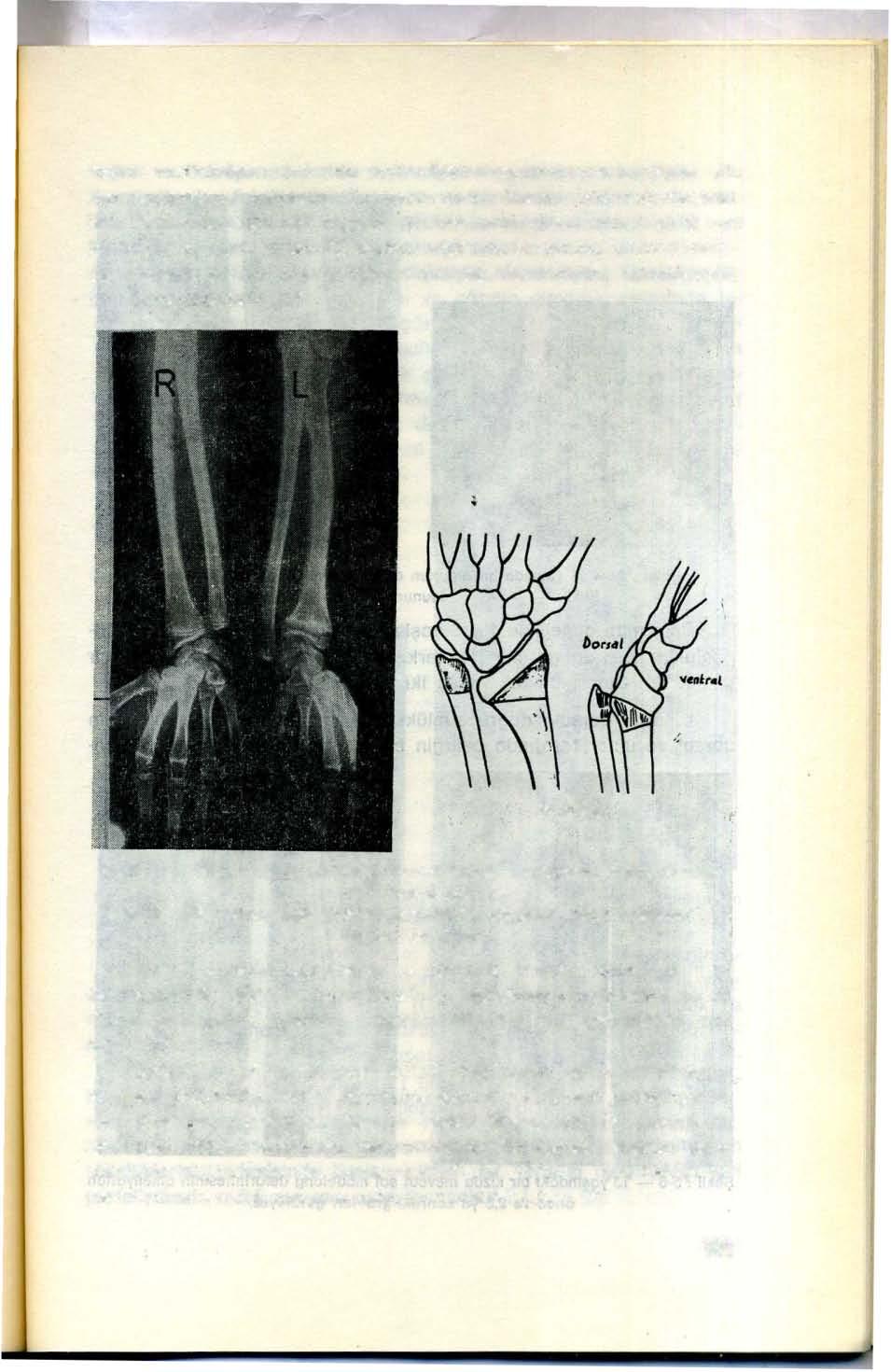 radius normalden daha kısa kalır. Radial epifizin medial yarısı erken kapanmaya meyillidir. Radiusun ulnar kenan poyunca oseofitlerin bulunabileceği belirtilmiştir (8).