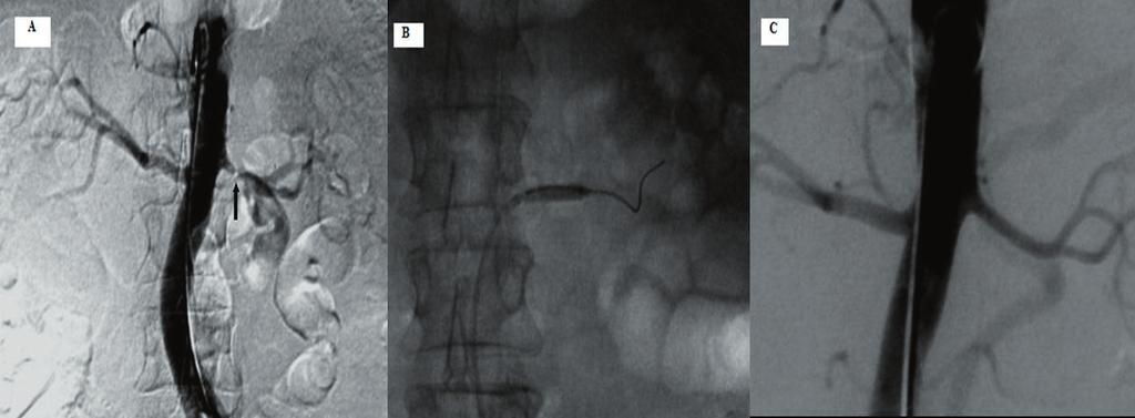 Cilt : 25 Sayı : 3 O.G.Gümüştaş, İ.Akdağ, Y.Sadıkoğlu Resim 1. (A) Abdominal aortagrafi. Sol renal arter proksimal trunkus yerleşimli %90 ýn üzerinde darlık izleniyor (ok).