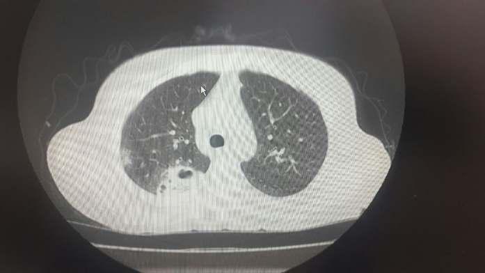 BT- Sol akciğer alt lobda asinenodüler infiltrasyon alanları dikkati çekmektedir. Sağ akciğer üst lob posterior kesimde kaviteleşme gösteren konsolidasyon alanı izlenmektedir.