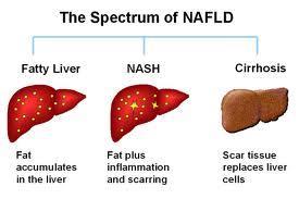 NAFLD (Non-alcoholic fatty liver disease) NAFLD hepatik steatozdan NASH (non-alkolik steatohepatit) ve