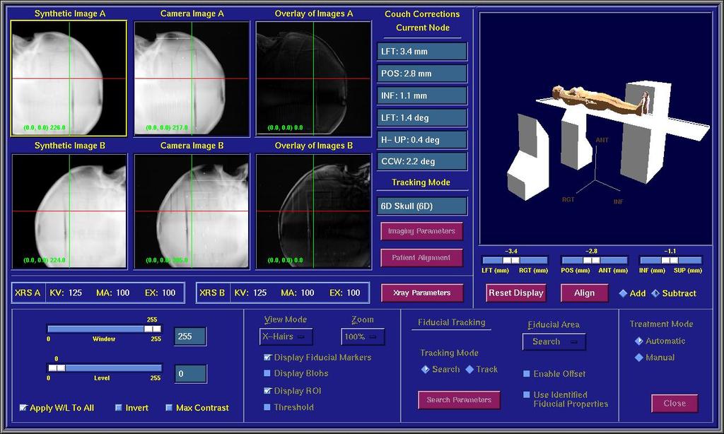 Cyberknife Tedavi Metodları