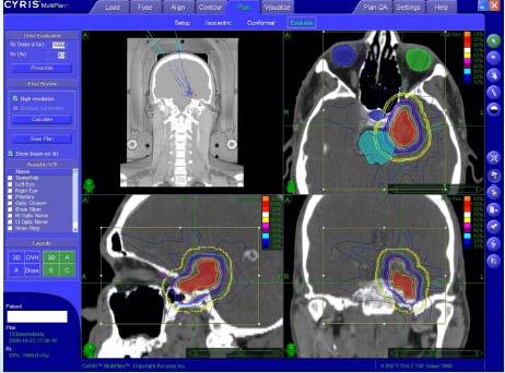 İntrakraniyal Cyberknife