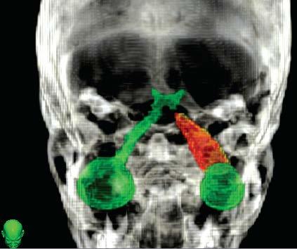 İntrakraniyal Cyberknife Uygulamaları Optik Sinir Meningioma Tümör hacmi 3.