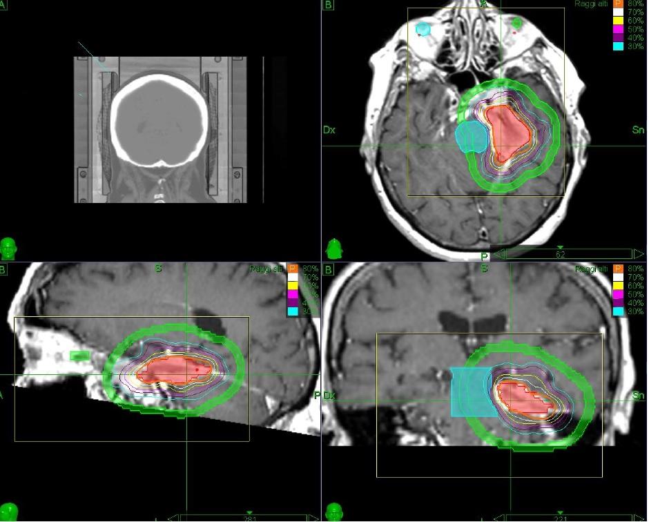 İntrakraniyal Cyberknife Uygulamaları