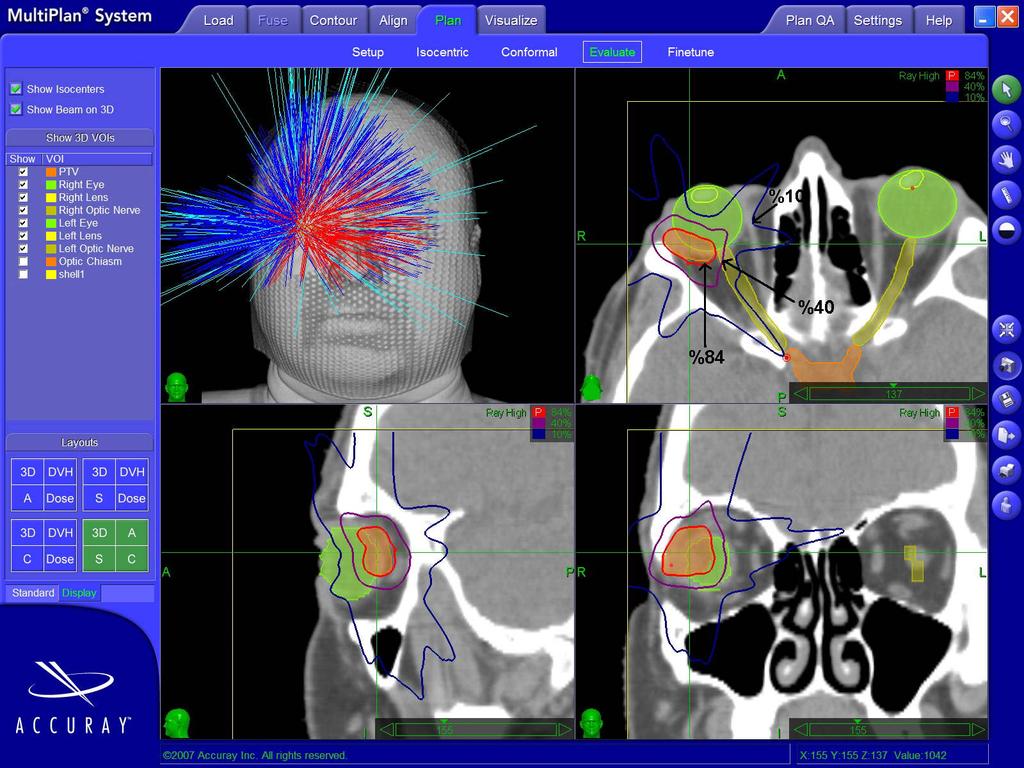 İntrakraniyal Cyberknife