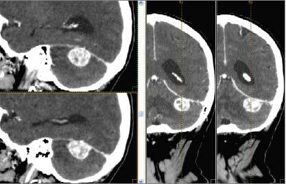 İntrakranyal Cyberknife Uygulamaları