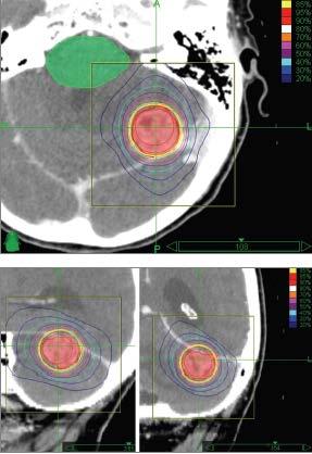 İntrakranyal Cyberknife Uygulamaları Renal tümör Beyin mtz.