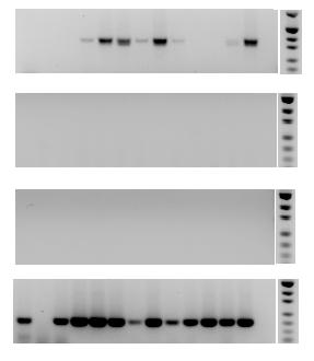 4.2 PCR Amplifikasyonlarının Agaroz Jeldeki Görüntüleri Normal ve hasta kemik iliği örneklerinden izole edilen hücre fraksiyonlarının total RNA larından ters transkriptaz ile sentezlenen cdna
