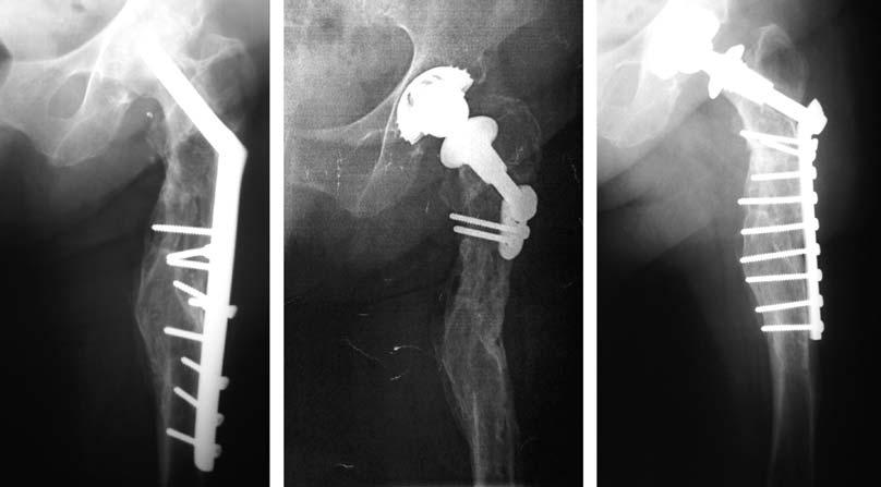 438 Acta Orthop Traumatol Turc (a) (b) (c) fiekil 1. (a) Proksimal femoral deformiteli travmatik koksartrozu olan 74 yafl ndaki kad n hastan n radyografisi. (b) Ameliyat sonras 3.