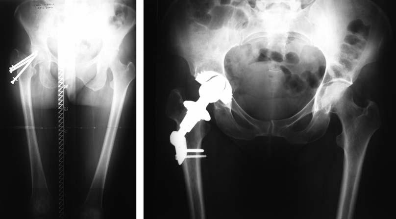 Karatosun ve ark. Proksimal femur deformitesinde plakl kalça protezi 439 (a) (b) fiekil 3.