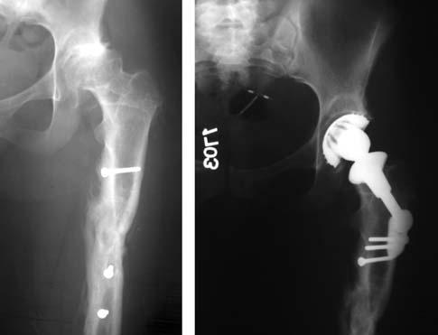 75) olup yedisi kad n sekizi erkekti. Oniki olguda etyoloji travmatik koksartroz iken, üç olguda femur boynu k r kaynamamas ile birlikte femur bafl nda avasküler nekrozdu (fiekil 1-3).