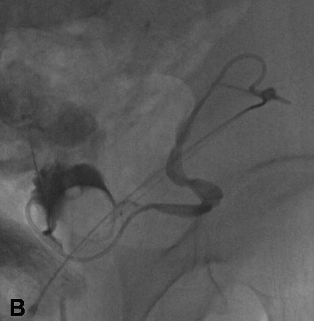 B. ve C. Renal pelvise giriş sonrasında mikrotelin gönderilmesi. D. Renal pelvisteki double J stentin komşuluğuna nefrostomi kateterin ilerletilmesi.