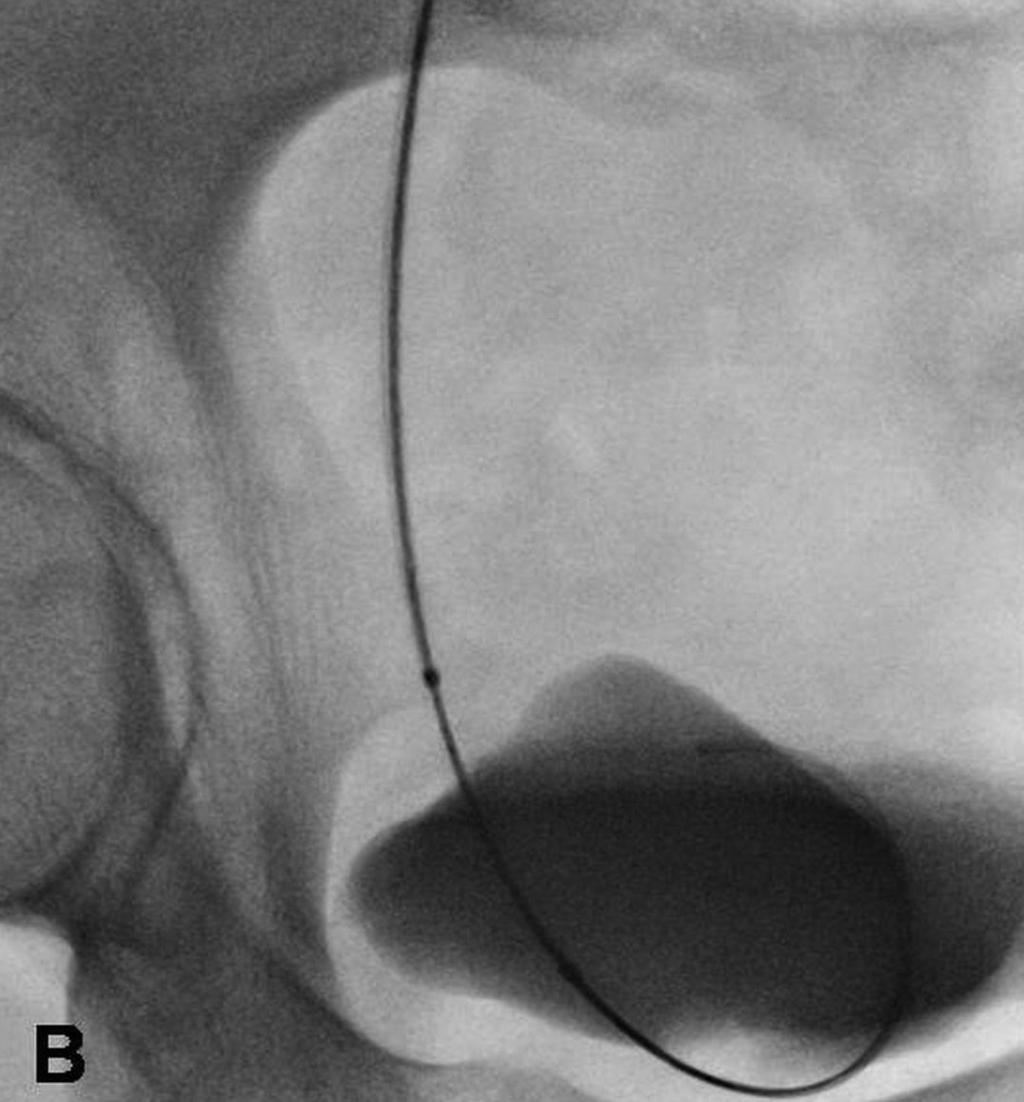 yerleştirilmesi. A. Antegrad pyelogramda, prone pozisyonda sol renal pelvis ve üreterin opasifikasyonu. B ve C.