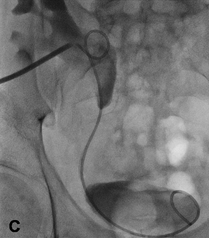 Stent malfonksiyonunun sık nedenlerinden biri idrar kristallerinin birikimine bağlı stentin iç ya da dış yüzeyinde taşlaşma olmasıdır (10). Üreter stenti 4-8 haftada bir değiştirilmelidir.