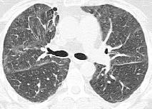 ZM R GÖ ÜS HASTANES DERG S Respiratuar bronfliyolit ile iliflkili interstisyel akci er hastal Hastal k genellikle 30-40 l yafllarda ortaya ç kar ve daha çok erkekleri tutar (2,3,8).
