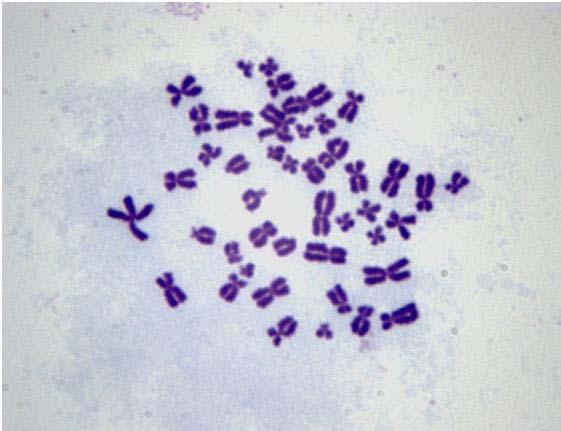 gözlenen kromozom anormallikleri a) kromatid kırığı, b)