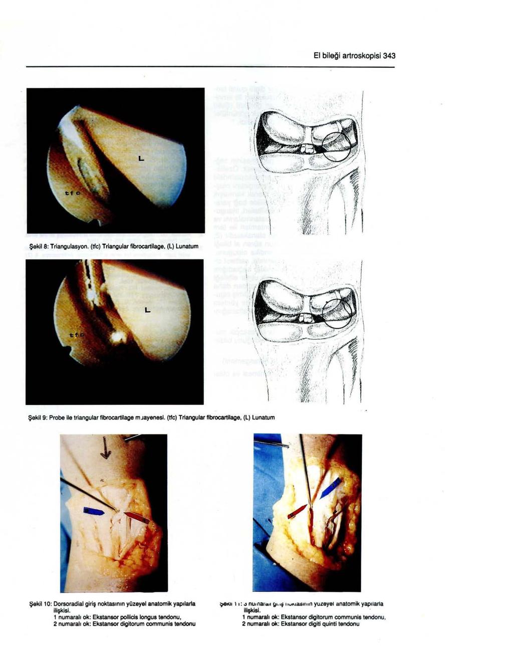 EI bileği artroskopisi 343 : " Şekil 8: Triaooulasyon. (tfc) Triangular fibrocartilage. (L) Lunatum,.,, ': :,' Şekıl 9: Probe Ile trlangular flbrocartilage mjayenesl. (tfc) Trlangular flbrocartllage.